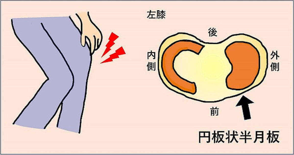 外側円板状半月板の形状イメージ