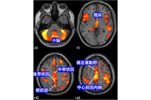 拒食症の重症度と脳灰白質の体積に見られた相関とは - NCNPなどの共同研究