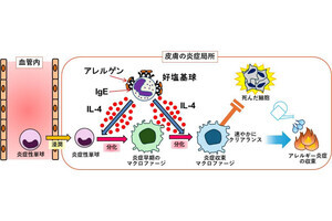 皮膚アレルギーを炎症性単球が変化し抑制する、東京医科歯科大が発見