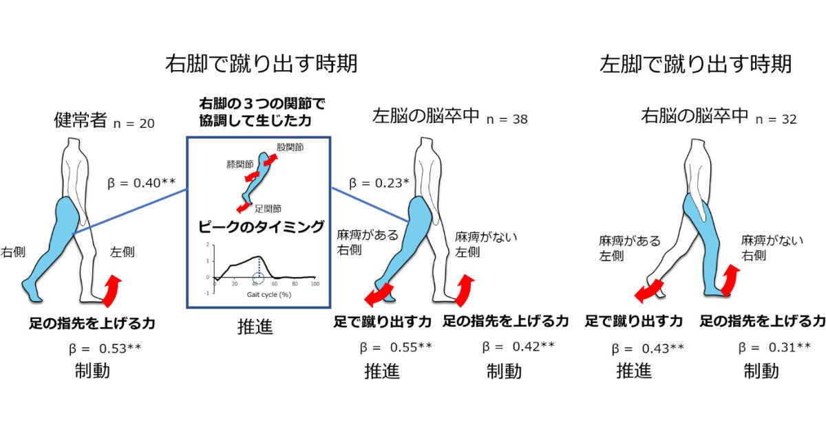 東北大、左脳と右脳の脳卒中では歩行速度低下の要因が異なることを確認：マピオンニュース