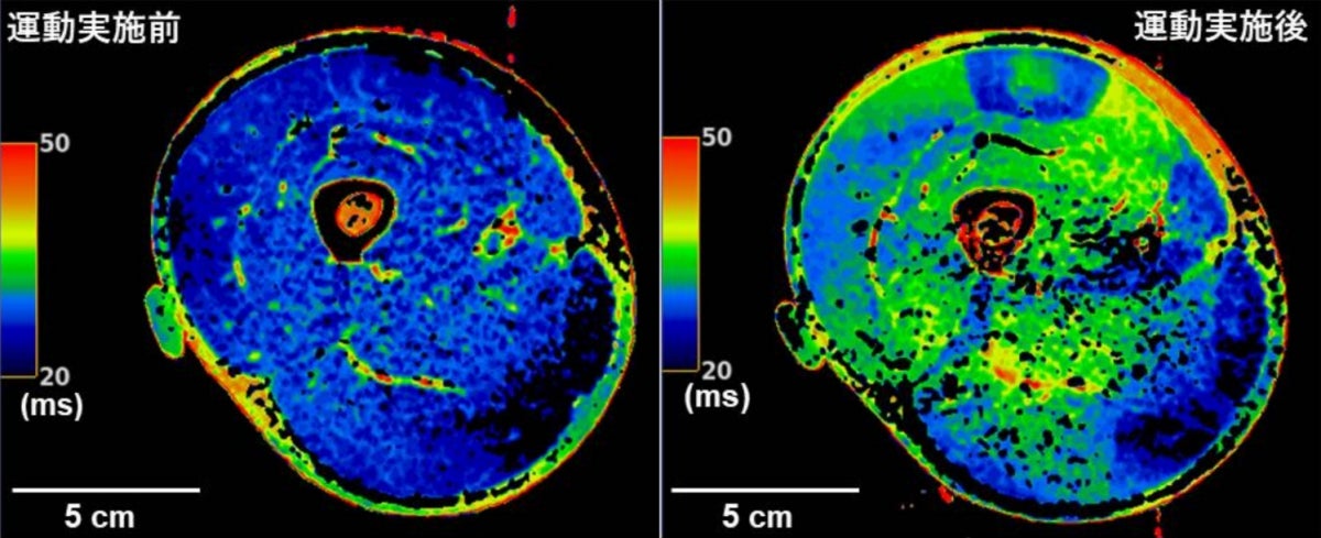 高強度間欠的運動実施前後の大腿部のMRIの横断画像例