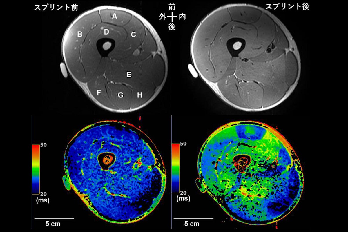 スプリント実施前後の大腿部のMRIの横断画像例