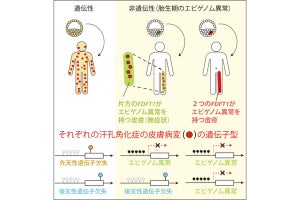 神戸大など、汗孔角化症の一部は「エピゲノム異常」で起きることを確認