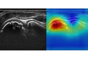 “野球肘”の早期病変を超音波画像から高精度で発見するAIを開発