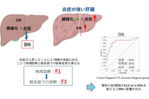 広島大、肝臓病を超音波を用いて正確に診断する新たな検査方法を発見　