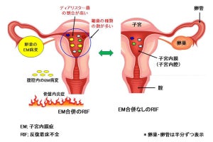 反復着床不全で子宮内膜症の患者、歯周病菌を子宮内から高頻度に検出 山梨大など