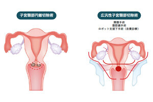 妊娠の可能性を残す子宮頸がん治療の新術式開発へ - 岡山大が患者を募集