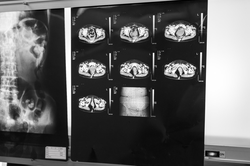 近未来テクノロジー見聞録 第214回 ウィスコンシン大学がAIで腹部CT画像から将来の死亡リスクを予想